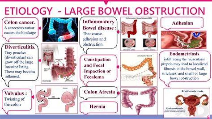 Can a bowel blockage cause nausea?