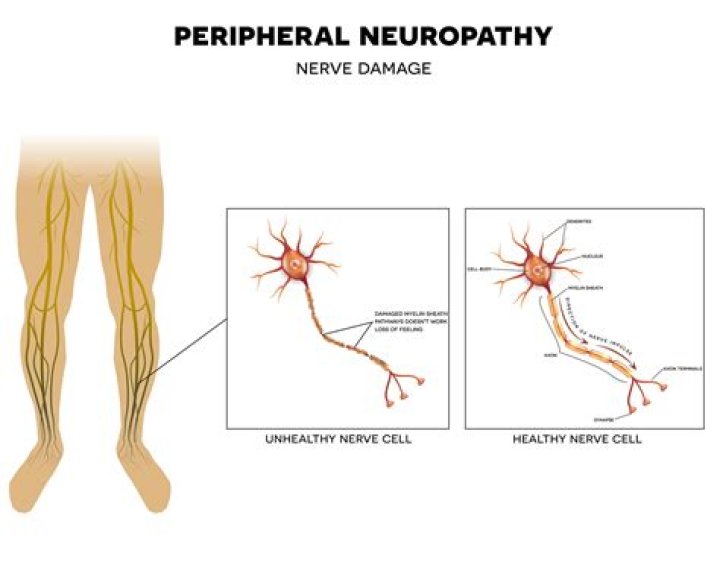 Can dysautonomia cause peripheral neuropathy?