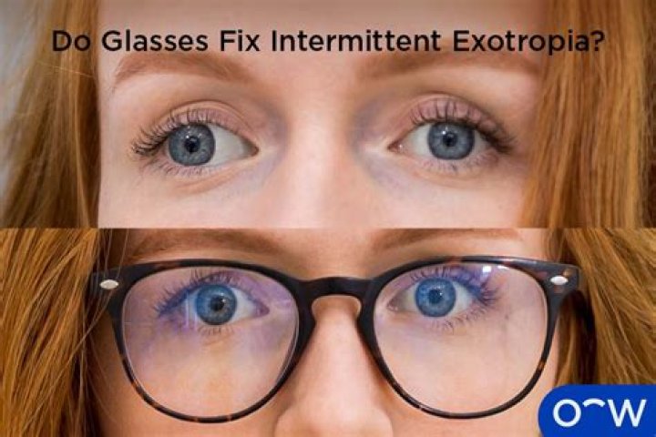 Can intermittent exotropia go away?