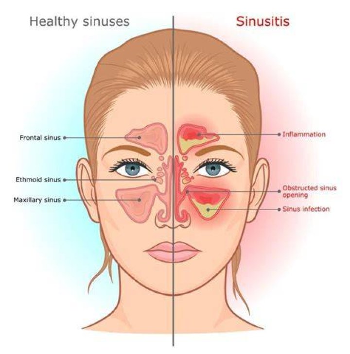 Can sinusitis cause scalp tenderness?
