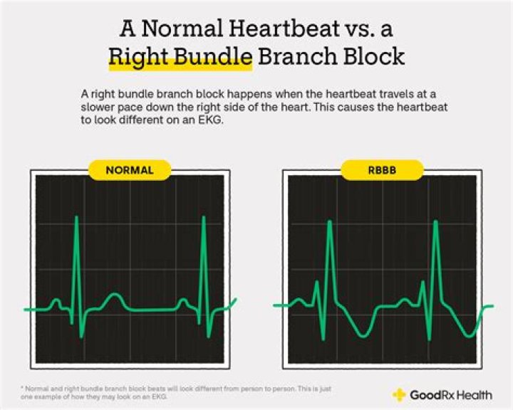 Does bundle branch block increase heart rate?
