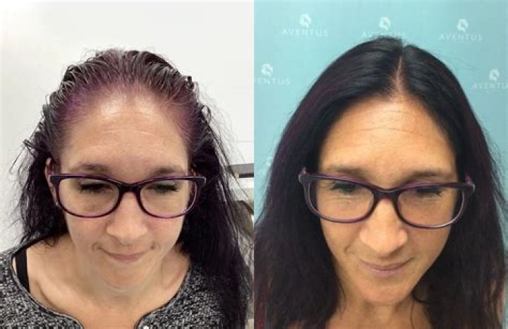 Does hair PRP really work?