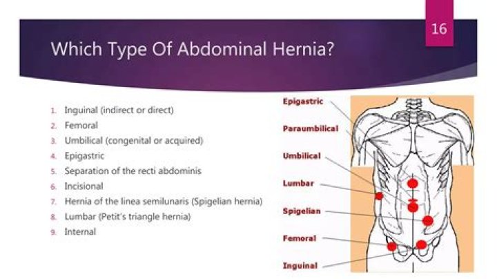 How do you describe an abdominal hernia?