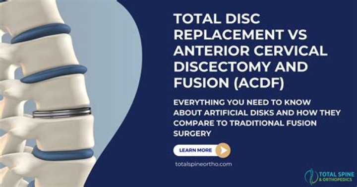 How many years does ACDF last?