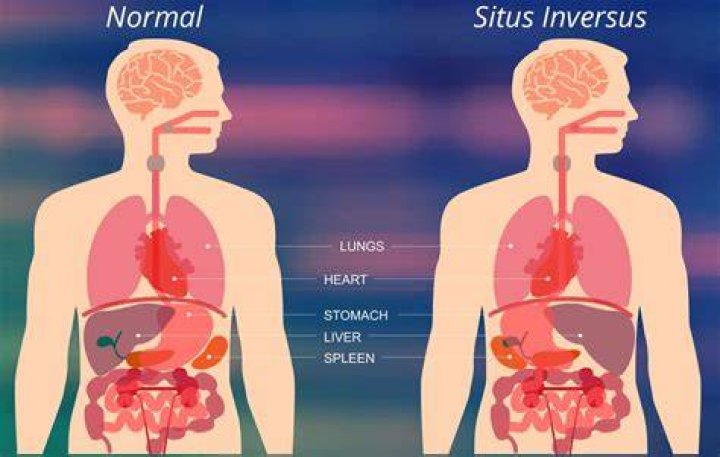 Is situs inversus hereditary?
