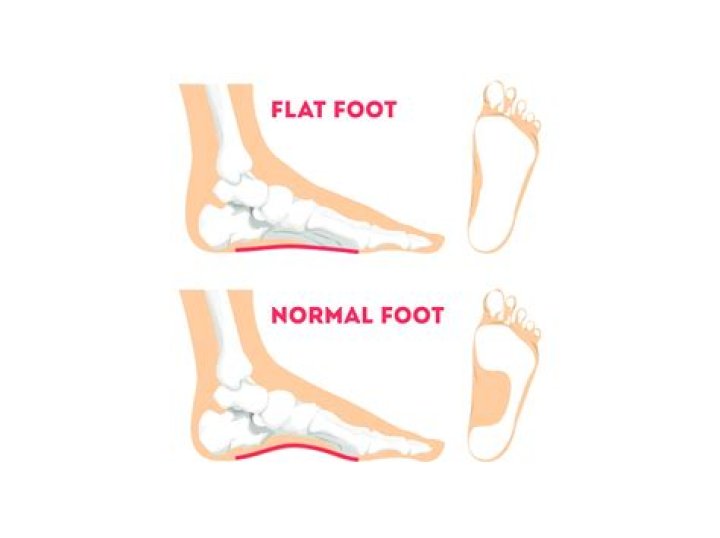 Is walking bad for flat feet?