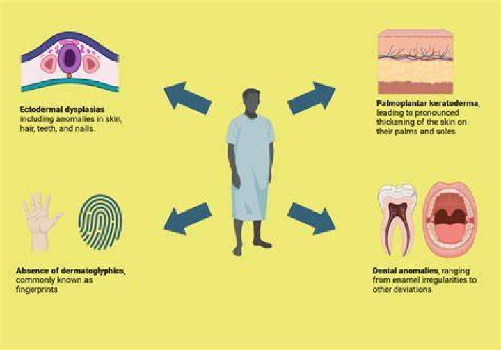 What causes Naegeli syndrome?