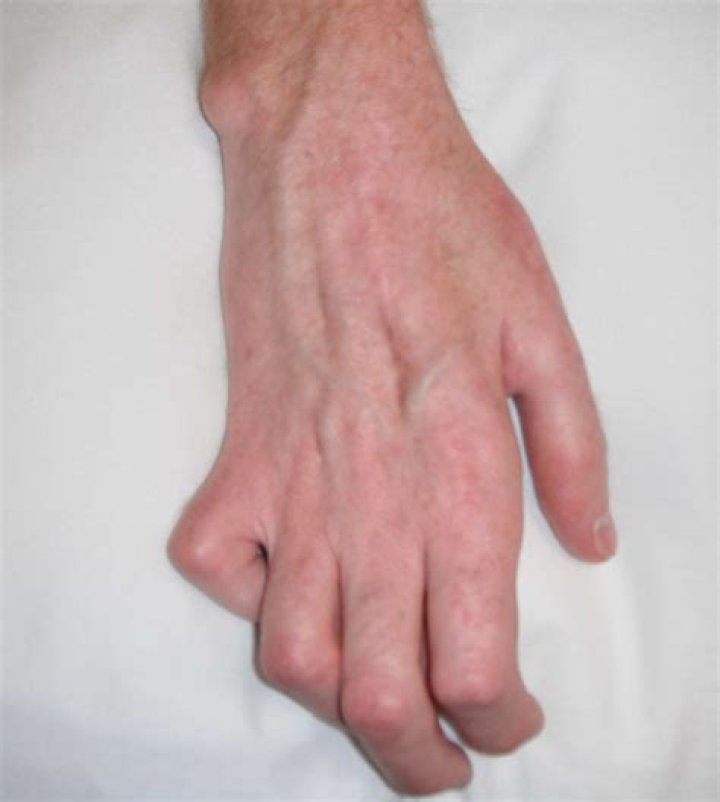What causes palsy in the hands?