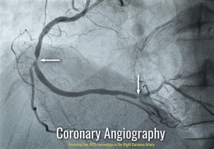 What does a angiogram do?