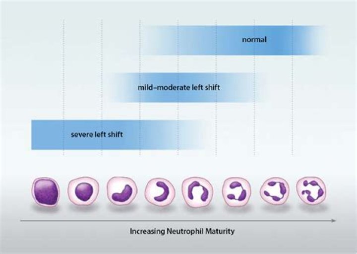 What does a left shift in neutrophils mean?