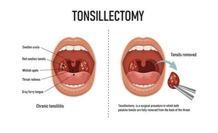 What does exudate on tonsils mean?