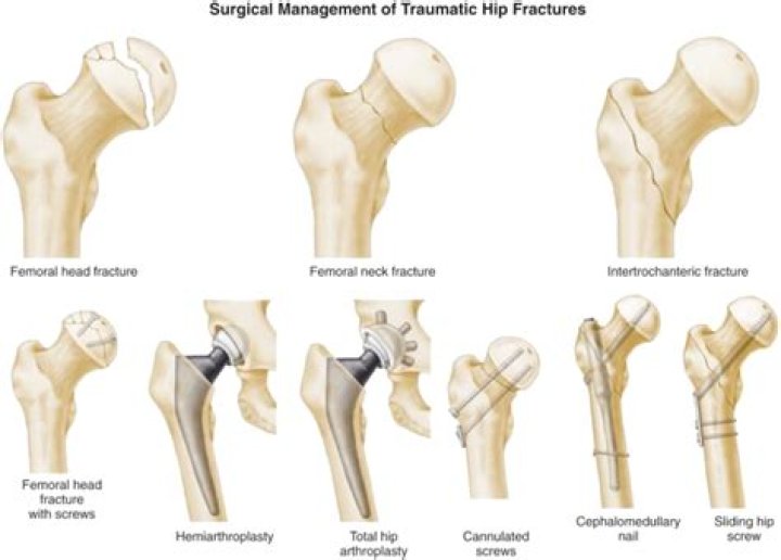 What is a Basicervical femur fracture?