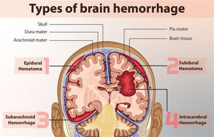What is a cortical hemorrhage?