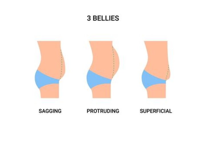 What is a protruding belly called?