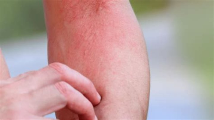 What is internal itching?