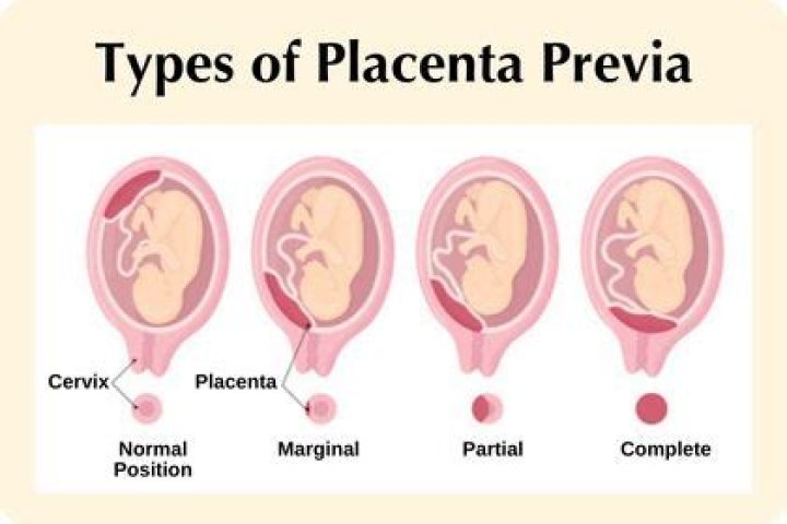 What is placenta previa Marginalis?