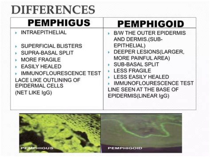 What is the difference between pemphigoid and pemphigus?