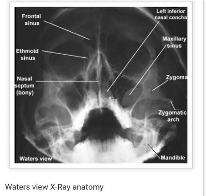 What is Waters view sinus X-ray?
