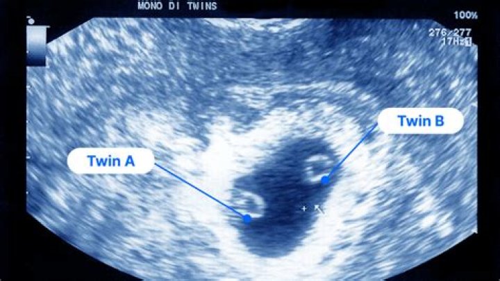 When does twin pregnancy become uncomfortable?